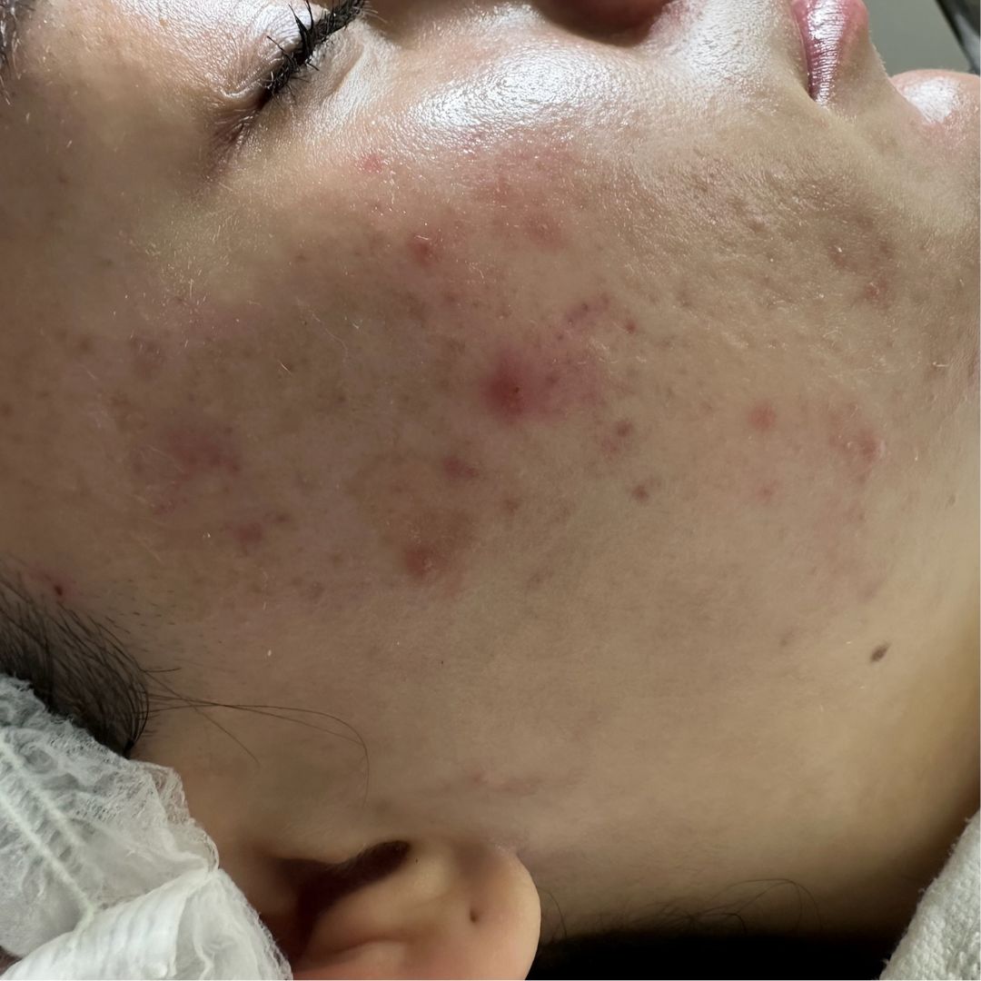 Gesicht voller Akne und Verschmutzungen