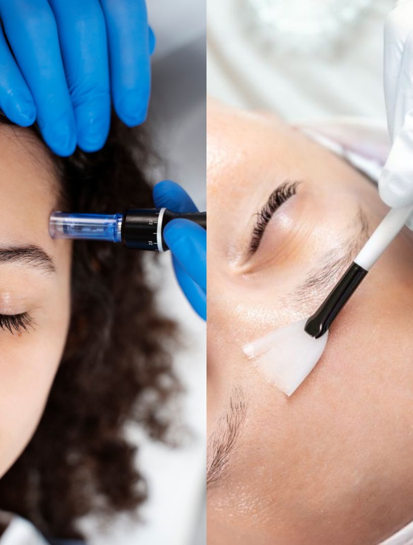 Kombinierte Microneedling + Fruchtsäure Behandlung ist die beste Methode um Akne zu entfernen