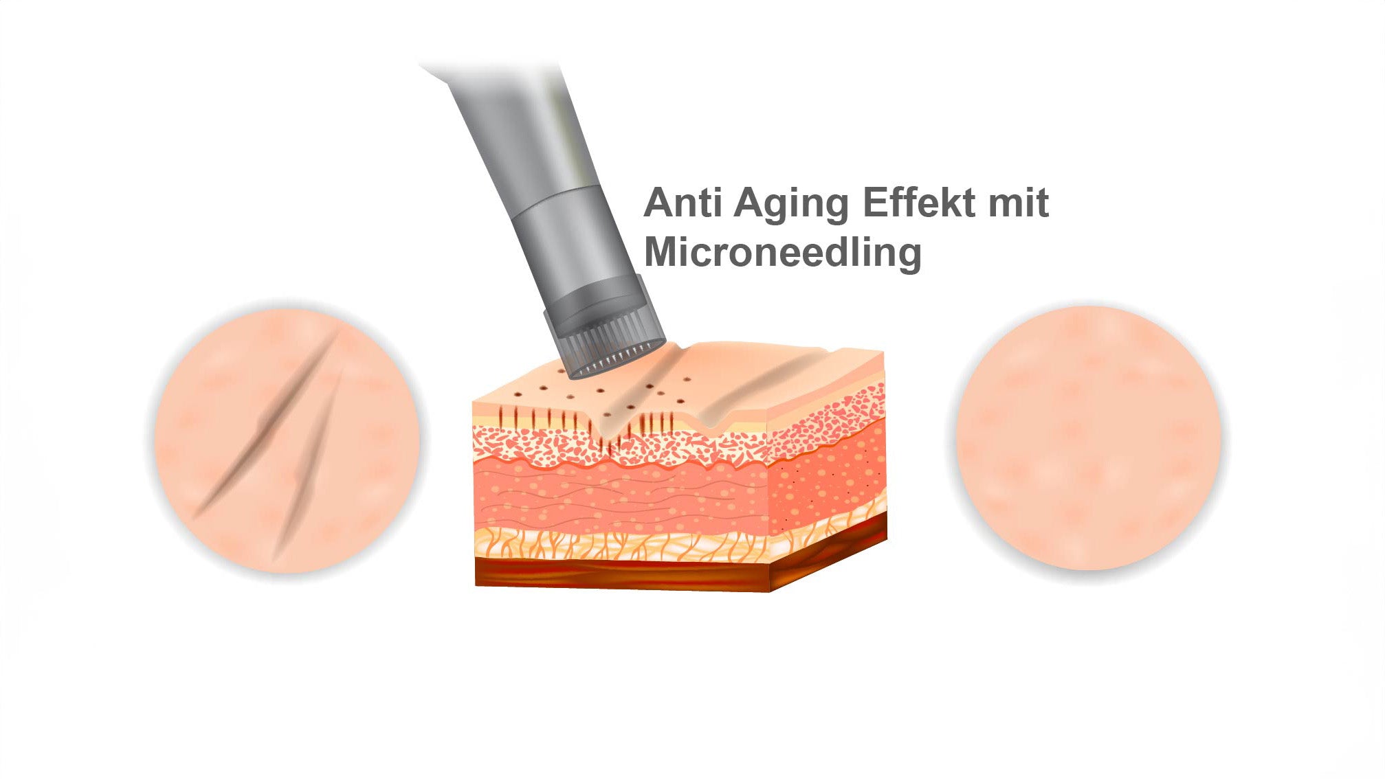Anti Aging Effekt mit Mirconeedling